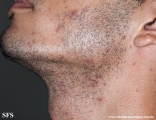 pseudofolliculitis barbae