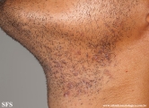 pseudofolliculitis barbae