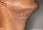 pseudofolliculitis barbae