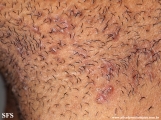 pseudofolliculitis barbae