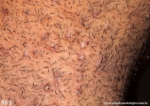 pseudofolliculitis barbae