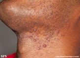 pseudofolliculitis barbae