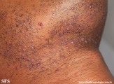 pseudofolliculitis barbae
