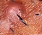 pseudofolliculitis barbae