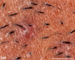 pseudofolliculitis barbae