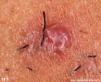 pseudofolliculitis barbae