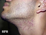 pseudofolliculitis barbae