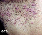 pseudofolliculitis barbae