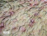 pseudofolliculitis barbae