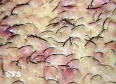 pseudofolliculitis barbae