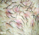 pseudofolliculitis barbae
