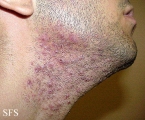 pseudofolliculitis barbae