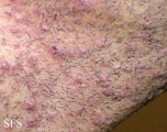pseudofolliculitis barbae