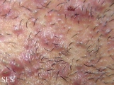 pseudofolliculitis barbae