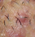 pseudofolliculitis barbae