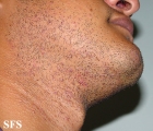 pseudofolliculitis barbae