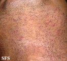pseudofolliculitis barbae