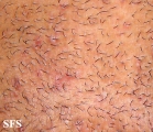 pseudofolliculitis barbae