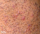 pseudofolliculitis barbae
