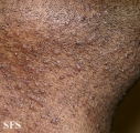 pseudofolliculitis barbae