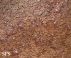 pseudofolliculitis barbae