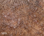 pseudofolliculitis barbae