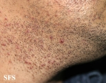 pseudofolliculitis barbae