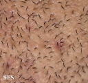 pseudofolliculitis barbae