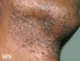 pseudofolliculitis barbae