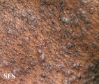 pseudofolliculitis barbae