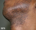 pseudofolliculitis barbae