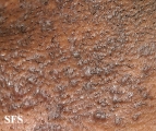 pseudofolliculitis barbae