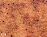 pseudofolliculitis barbae