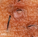 pseudofolliculitis barbae