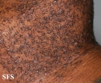 pseudofolliculitis barbae