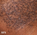 pseudofolliculitis barbae