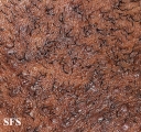 pseudofolliculitis barbae