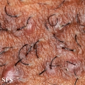 pseudofolliculitis barbae