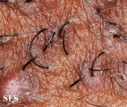pseudofolliculitis barbae