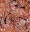 pseudofolliculitis barbae