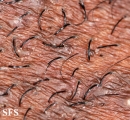 pseudofolliculitis barbae