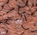 pseudofolliculitis barbae