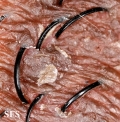 pseudofolliculitis barbae
