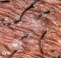 pseudofolliculitis barbae