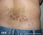 neurofibromatosis-segmental neurofibromatosis