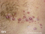 neurofibromatosis-segmental neurofibromatosis
