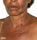 neurofibromatosis-segmental neurofibromatosis