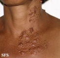 neurofibromatosis-segmental neurofibromatosis