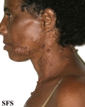 neurofibromatosis-segmental neurofibromatosis