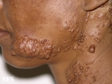 neurofibromatosis-segmental neurofibromatosis